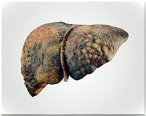 liver with cirrhosis