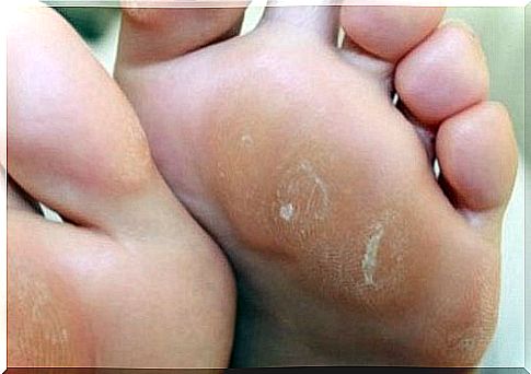 4 home treatments to treat calluses on the skin