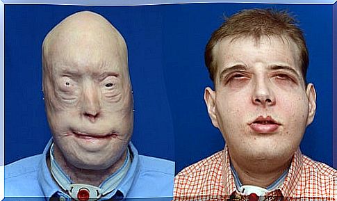 41-year-old firefighter receives the most complete face transplant in history