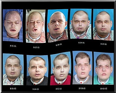 face transplant steps