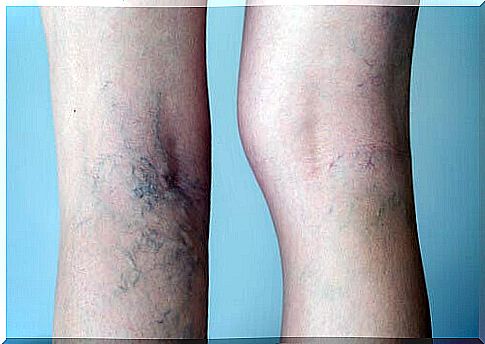 Woman with varicose veins from wearing heels