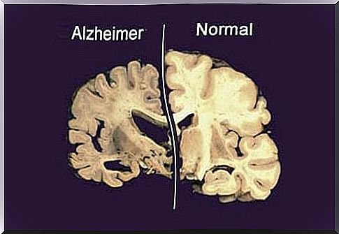 prevent_the_alzheimer_brain_with_alzheimer