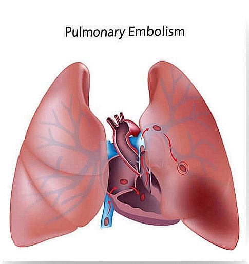 Everything you need to know about pulmonary thromboembolism