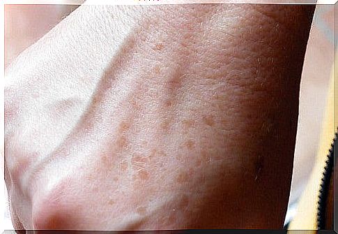 How to disguise or eliminate blemishes and freckles on your hands?