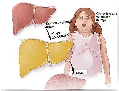 fatty liver