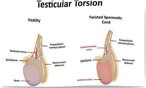 Sperm cord twist: symptoms and causes