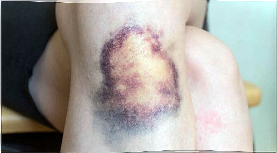 Knee hematoma