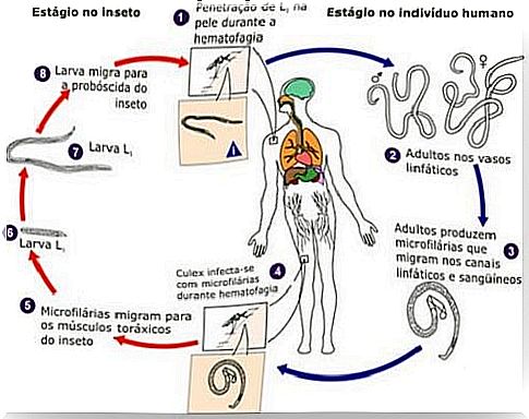 filariasis